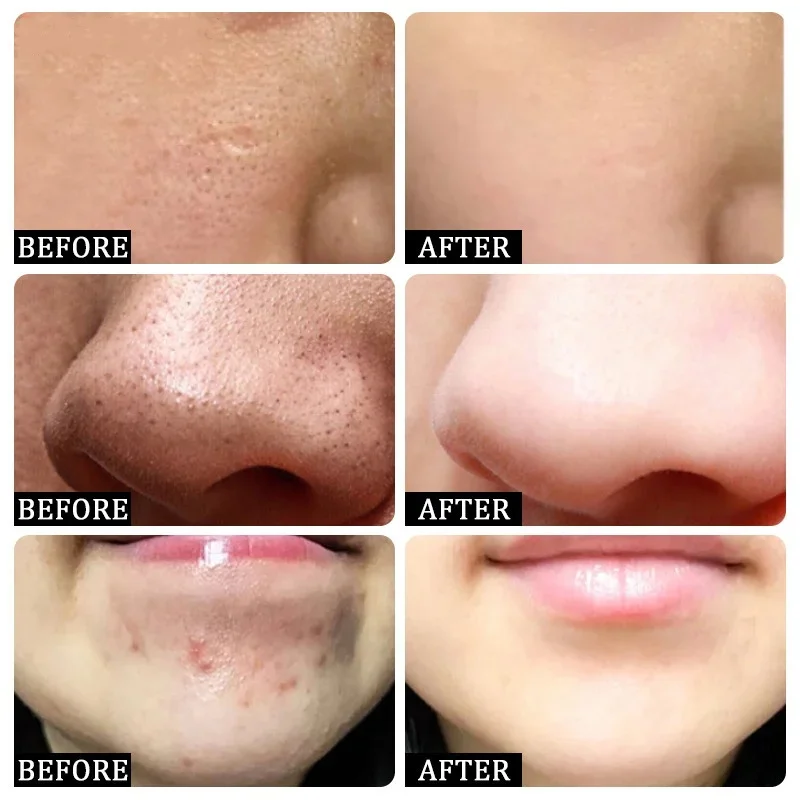 Ácido salicílico poros limpeza - Korean Skincare Routine avaliação e preço