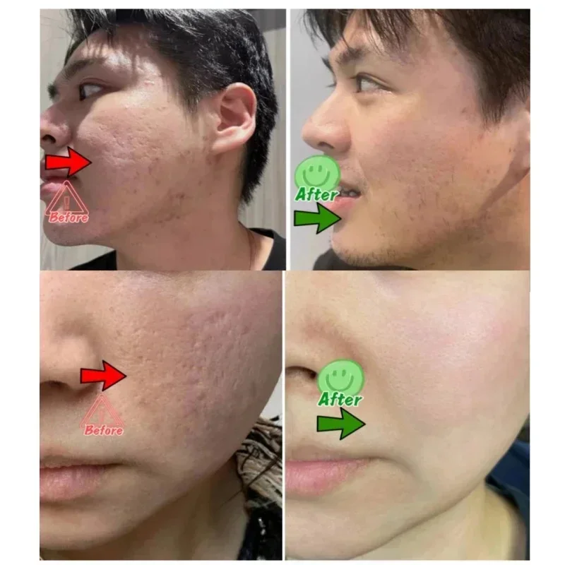 Ácido salicílico poros limpeza - Korean Skincare Routine avaliação e preço